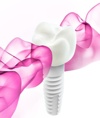 Zeramex by Dentalpoint AG